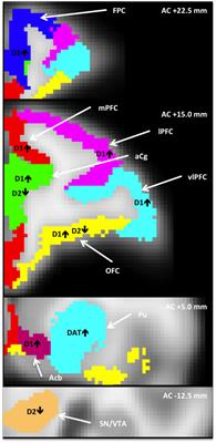 PET Measures of D1, D2, and DAT Binding Are Associated With Heightened Tactile Responsivity in Rhesus Macaques: Implications for Sensory Processing Disorder